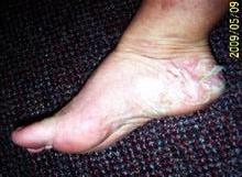 foot psoriasis before